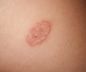 Fototapeta premium lichen on a person's buttock