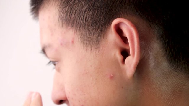 Close-up the side face of Asian teenage guy with acne and skin problems. Health and skin care concepts.