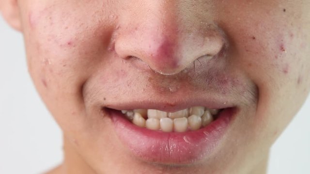 Close up face of Asian teenage guy with acne and problem skin. Health and skin care concepts.