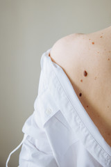 A woman's shoulder is naked. the white shirt fell off the white shoulder. There are many large and small moles on the shoulder.