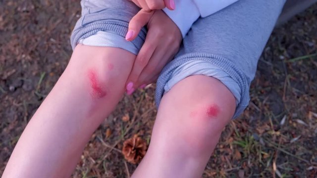 Knees trauma of young woman with abrasions on nature after faling, closeup view. Wound, abrasion, trauma, injuries, pain, bruise of legs. Outdoor sport and activity on nature.