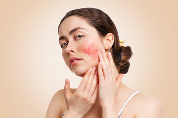 Portrait of a young pretty Caucasian woman who frowns and shows reddened and inflamed cheeks. Beige...