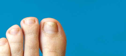 panoramic images of toe with nail psoriasis. A woman has an ingrown toenail. short cutted nails....