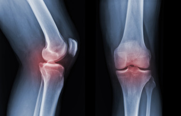 X-ray knee radiograph show state of injury