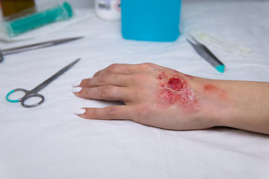 Wasserverbr&uuml;hung linke Hand