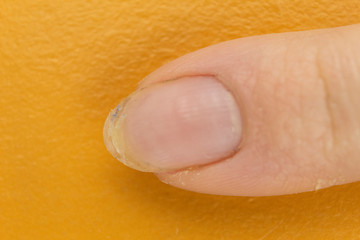 Onychomycosis of a nail disease in which the nails exfoliate
