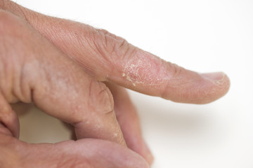 Trockene Haut, Mittelfinger, links, Detail