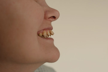 Bad bite. Crooked yellow teeth..