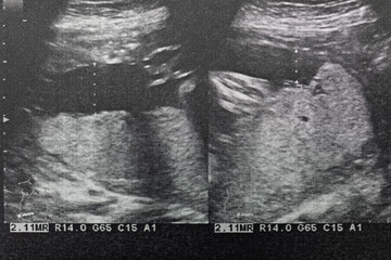Ultrasound of baby in pregnant woman, Doctor reading test results of pregnant woman by ultrasound.
