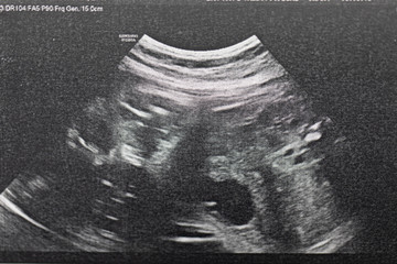 Ultrasound of baby in pregnant woman, Doctor reading test results of pregnant woman by ultrasound.
