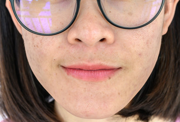 Close up of woman face has variety problems on her skin (such as Acne, Pimple, Pores and Melasma etc). Conceptual of natural problem on woman skin.