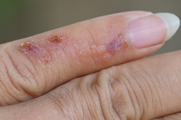 Skin disease caused by allergies around the little finger.