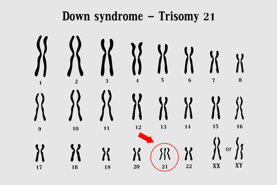 Karyotype of Down syndrome (DS or DNS), also known as trisomy 21, is a genetic disorder caused by the presence of all or part of a third copy of chromosome 21
