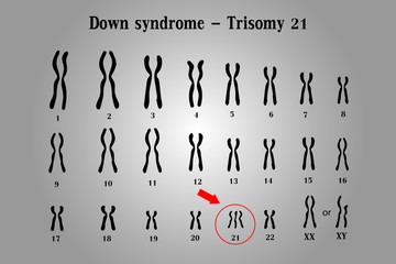 Karyotype of Down syndrome (DS or DNS), also known as trisomy 21, is a genetic disorder caused by the presence of all or part of a third copy of chromosome 21