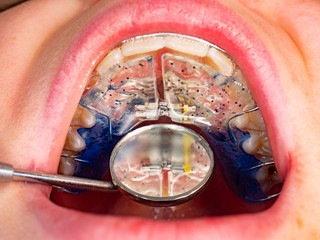 Dentist is check and set dimension of brackets.