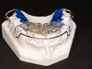 Plaster cast of teeth with partial  orthodontic retainer