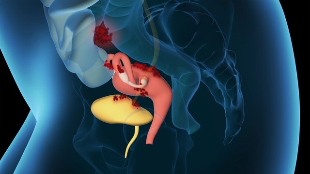 Endometriosis, female disease, 3D educational, medical illustration