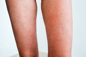 Severe sunburn, summer tan, poor sun protection. Sun allergies, obstruction, itching pain and blisters on the skin of the legs.