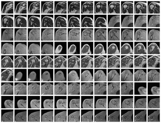 Complete Magnetic resonance of right Shoulder Joint