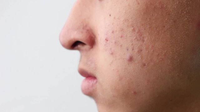 Close-up the side face of Asian teenage guy with acne and skin problems. Health and skin care concepts.