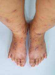 Skin diseases and skin wounds on the legs and feet of a person