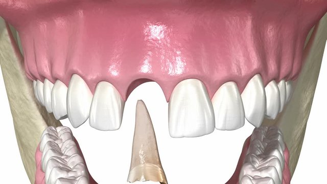 Bone grafting- augmentation using artificial bone and membrane, tooth implantation. Medically accurate 3D animation.