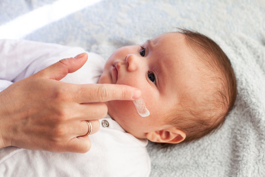 Baby With Atopic Dermatitis Getting Cream Put. Care And Prevention Of Eczema.