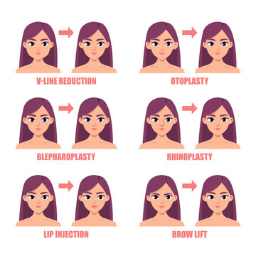 Types of plastic surgery on the face