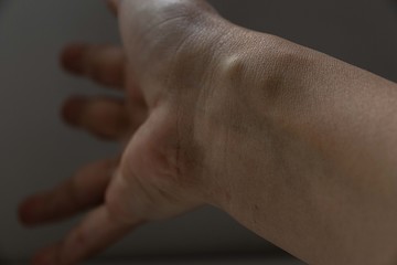 lump on the wrist. cyst on a woman's wrist.