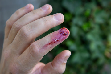 Fingernagel Verletzung
