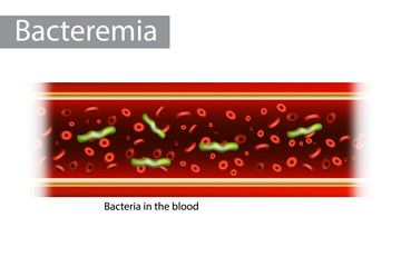 Bacteremia (also bacteraemia) is the presence of bacteria in the blood.