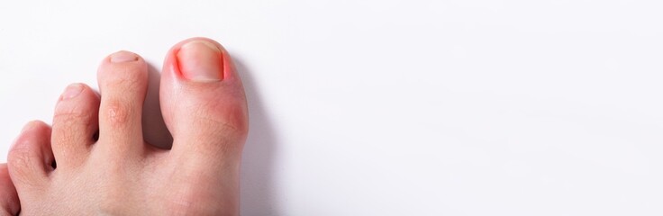 Close-up Of Sore Toe Nail