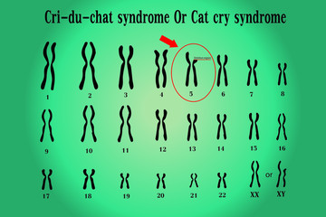 Cri du chat syndrome , also known as 5p- (5p minus) syndrome or cat cry syndrome, deletion of genetic material on the small arm (the p arm) of chromosome5.Genetic syndromes mentioned