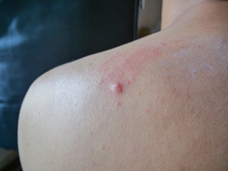 Fototapeta premium Skin allergic on the back
