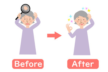 頭皮の薄毛に悩むおばあちゃんのビフォーアフター