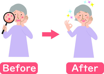 頭皮の吹き出物が気になるおばあちゃんのビフォーアフター