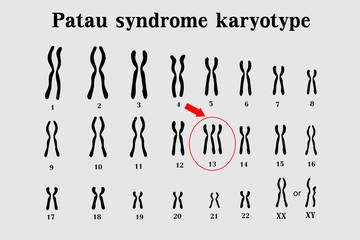 Fototapeta na wymiar Patau syndrome karyotype is the one of chromosomal disorders that have extra copy of chromosome 13