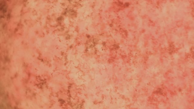 Fresh blood and insulin on microscope view. Blood smear under microscope present insulin (black fibers), white and red blood cells.