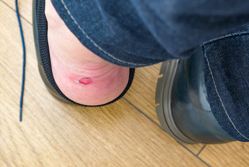 Male heel with bloody bursting callus. The problem of new uncomfortable shoes. Natural condition