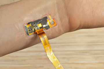 The chip is mounted under the skin. Chips embedding concept. Chip on wrist close up. Hand on scars after laser surgery.