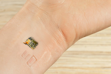 The chip is mounted under the skin. Chips embedding concept. Chip on wrist close up. Hand on scars after laser surgery.