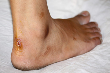 Fototapeta premium injury wound in male foot an accident