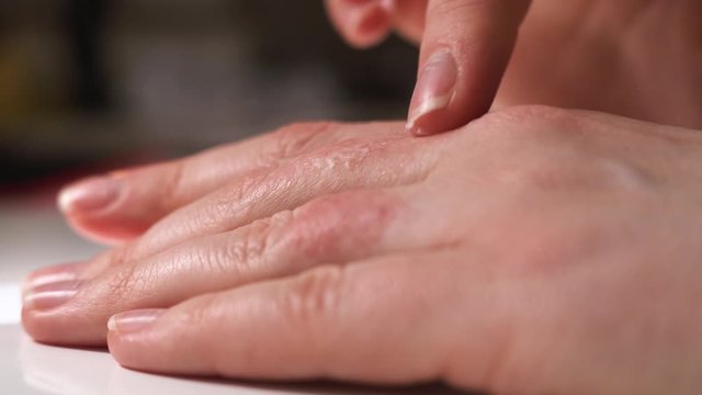 Girl or woman smears eczema on her hands with special healing ointment. Red swollen fingers require urgent treatment to improve patient health. Woman rubs two fingers. Close up macro.