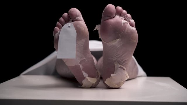 Pathologist in black gloves hangs blank white tag on foot of corpse. legs of girl or guy who died from illness are in morgue under white blanket. Dry pilled skin on the feet.