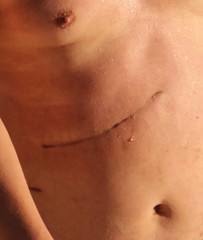 A scar from a cut with a knife on his stomach.