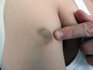 a bruised arm after the coup, body bruises,Bruises formed on the arm,