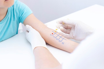 Allergen test on hand. child undergoing procedure of allergen skin test in clinic.