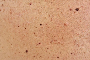 Many birthmark and moles on skin. photo 