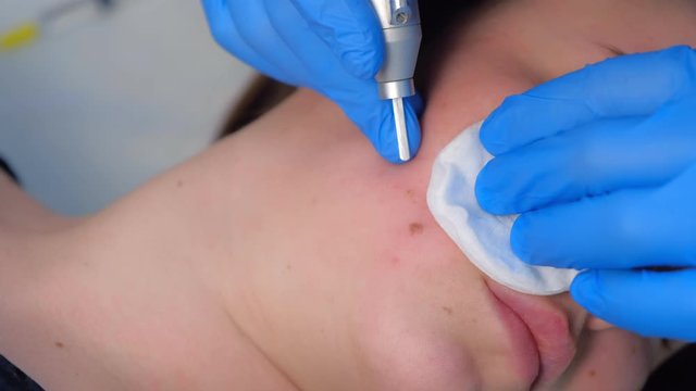 Process of removing mole using laser on woman's face by surgeon, burning skin, closeup view. Cosmetic treatment in beauty clinic. One day surgery concept. Removing birthmark surgical procedure.
