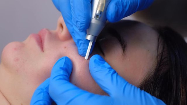 Surgeon removing mole using laser on woman face, burning skin, beauty treatment, closeup side view. Cosmetic treatment in beauty clinic. One day surgery concept. Removing birthmark surgical procedure.